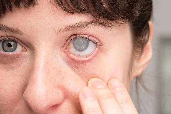 Glaucoma Testing and Treatment